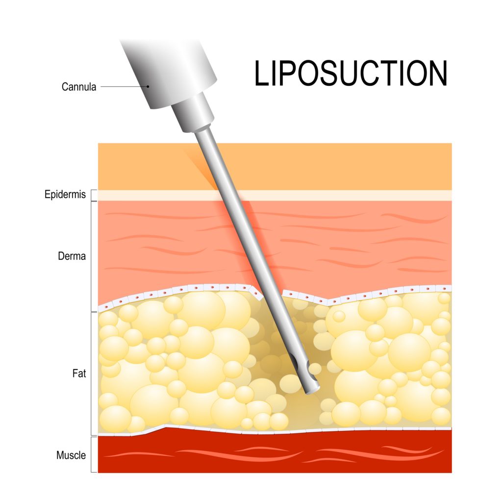 Here Are Types Of Liposuction You Need To Know Cellulite Geek