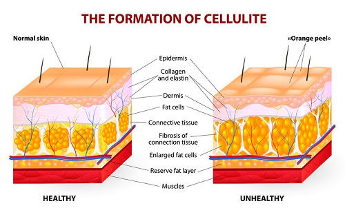 what is cellulite